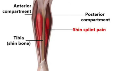 Shin Splints: What Are They and Why Do They Happen?