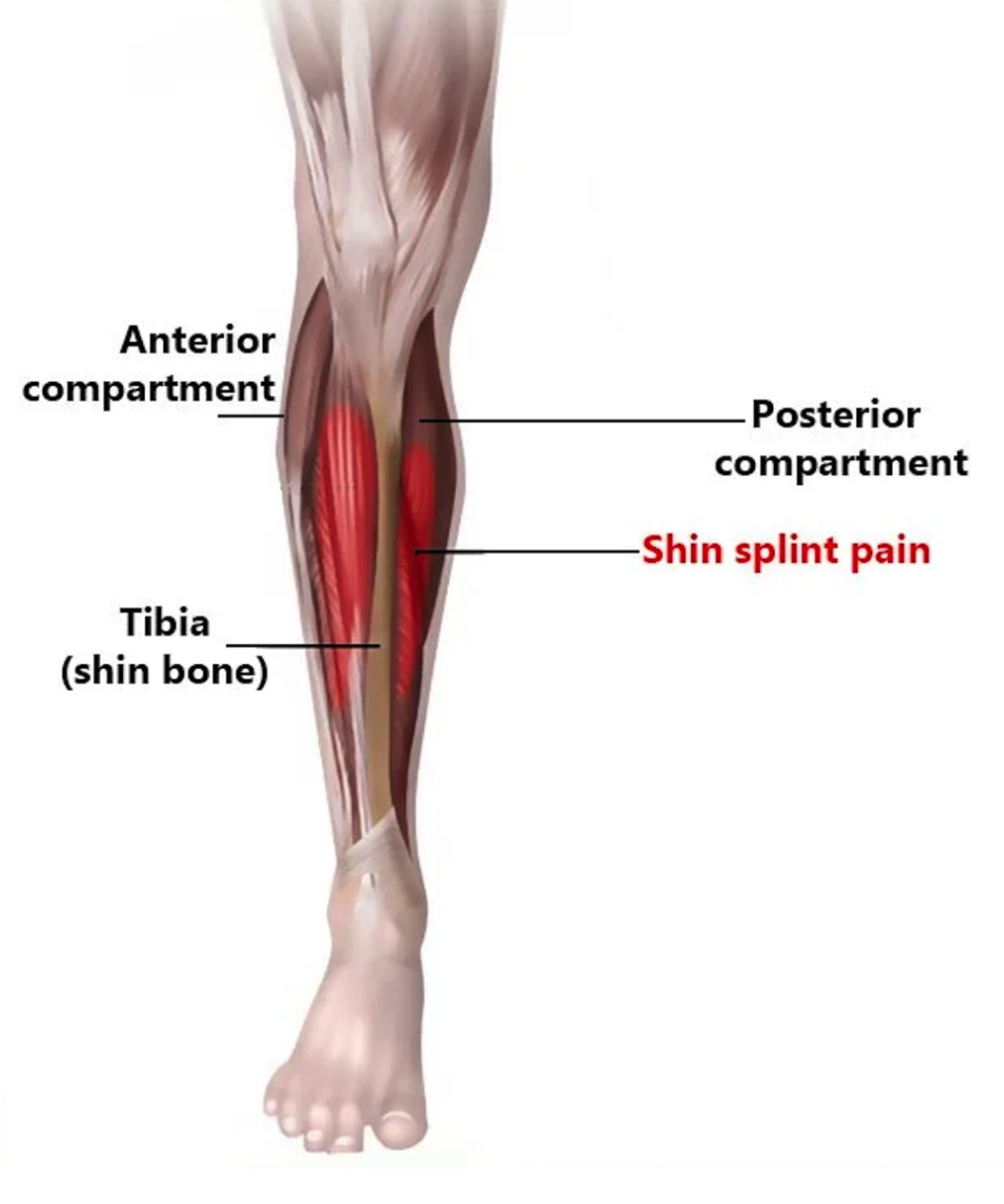 Shin Splints A diagram showing a leg and where shin splint pain is felt